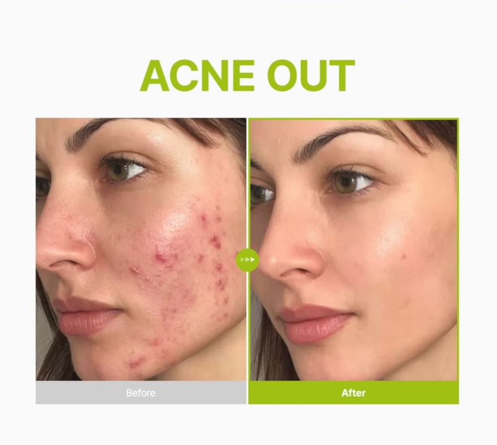Purito Azelaic Acid 10 Kojic Tea Tree Serum