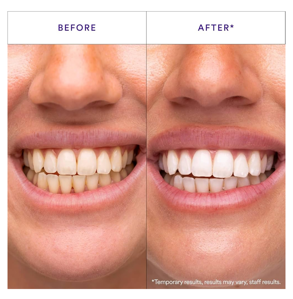 GlorySmile V34 Teeth Whitening Strips